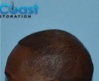 45-54 year old man treated with FUE Hair Transplant after 3624455