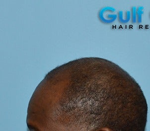 45-54 year old man treated with FUE Hair Transplant before 3624455
