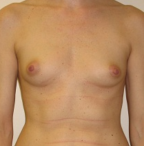 Breast Reconstruction before 1216632