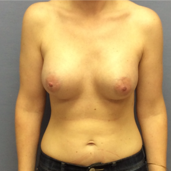 25-34 year old woman treated with Breast Augmentation after 3147448