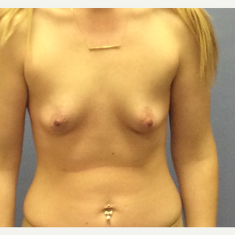 25-34 year old woman treated with Breast Augmentation before 3147448