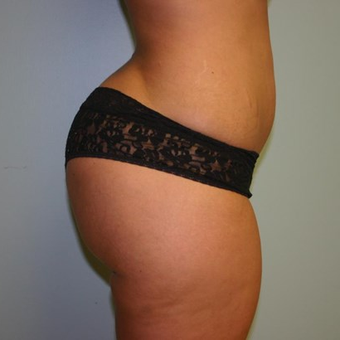 Brazilian Butt Lift after 3667463
