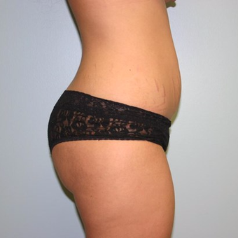 Brazilian Butt Lift before 3667463
