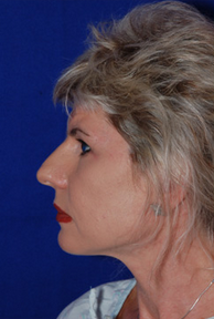 Nose Surgery before 1016876