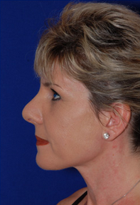 Nose Surgery after 1016876