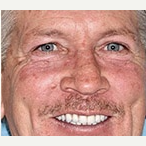 45-54 year old man treated with All-on-4 Dental Implants after 3691207