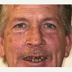 45-54 year old man treated with All-on-4 Dental Implants before 3691207