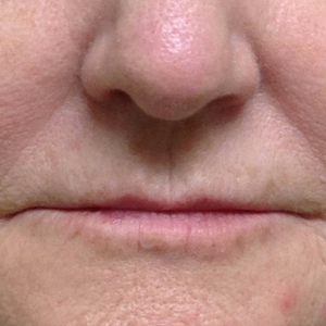 Woman treated with Volbella before 3603969