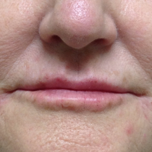 Woman treated with Volbella after 3603969