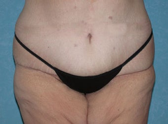 Circumferential Body Lift with Buttock Augmentation after 856591