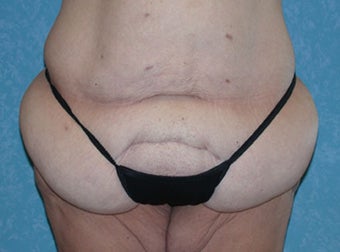 Circumferential Body Lift with Buttock Augmentation before 856591