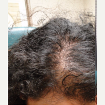 25-34 year old woman treated with PRP for Hair Loss before 3195487