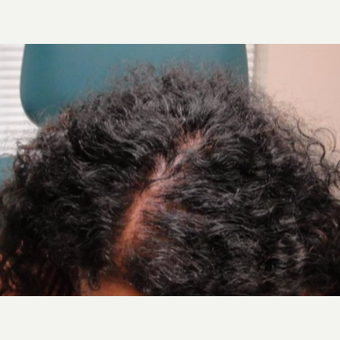 25-34 year old woman treated with PRP for Hair Loss after 3195487