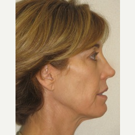 45-54 year old woman treated with Smart Lipo after 3143493