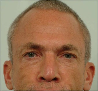 Botox between the eyebrows and across the forehead 444428