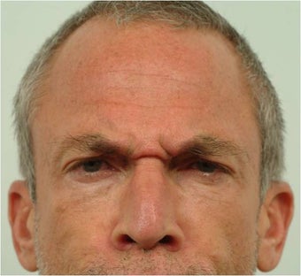 Botox between the eyebrows and across the forehead 444428