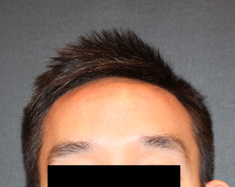 This is a 28 year old male who felt self-conscious of his large forehead. before 2724604