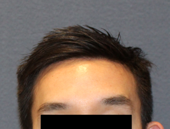 This is a 28 year old male who felt self-conscious of his large forehead. after 2724604