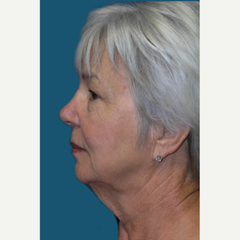 60 year old woman treated with Facelift and Necklift before 3465383