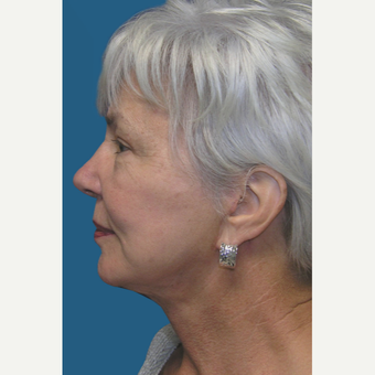 60 year old woman treated with Facelift and Necklift after 3465383