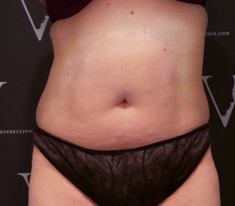 CoolSculpting before 3107141