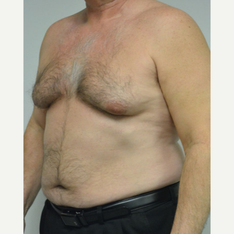 55-64 year old man treated with Male Breast Reduction before 3054058