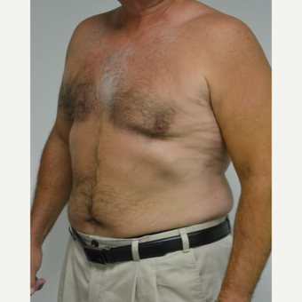 55-64 year old man treated with Male Breast Reduction after 3054058