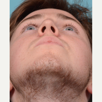 18-24 year old man treated with Rhinoplasty/Septoplasty before 3092665