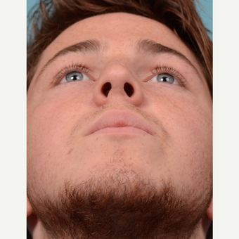 18-24 year old man treated with Rhinoplasty/Septoplasty after 3092665