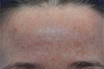 25-34 year old woman treated with Laser Treatment before 3141079