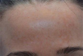 25-34 year old woman treated with Laser Treatment after 3141079