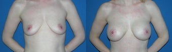 39 year old woman treated with Breast Augmentation before 2990392