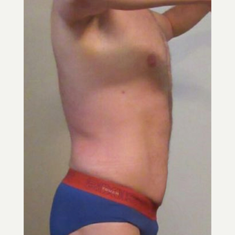 35-44 year old man treated with Mini Tummy Tuck and Liposuction chest, waist, back after 3848439