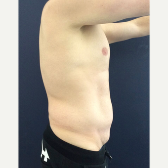 35-44 year old man treated with Mini Tummy Tuck and Liposuction chest, waist, back before 3848439