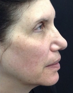 65 year-old woman treated for laxity with Pelleve after 2112694