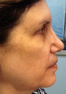 65 year-old woman treated for laxity with Pelleve before 2112694