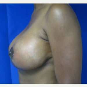 45-54 year old woman treated with Breast Lift after 3055020