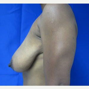 45-54 year old woman treated with Breast Lift before 3055020