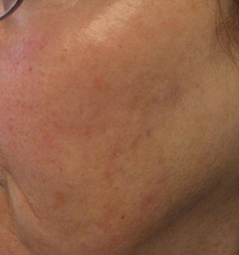 67 year old female with unwanted pigmentary changes on face after 694169