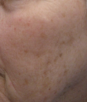 67 year old female with unwanted pigmentary changes on face before 694169