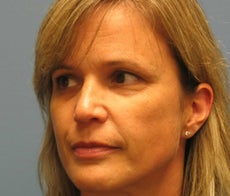 Woman in 40s treated for wrinkles before 894888