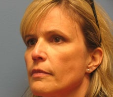 Woman in 40s treated for wrinkles after 894888