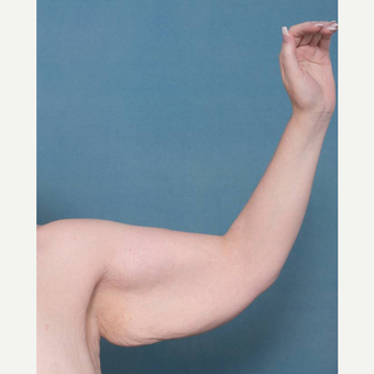 35-44 year old woman treated with Arm Lift before 3455685