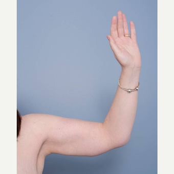 35-44 year old woman treated with Arm Lift after 3455685