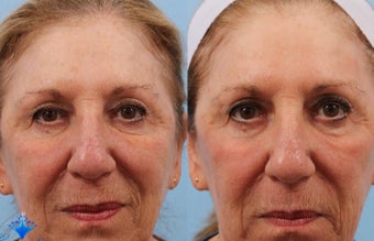 65-74 year old woman treated with Laser Treatment before 3623726