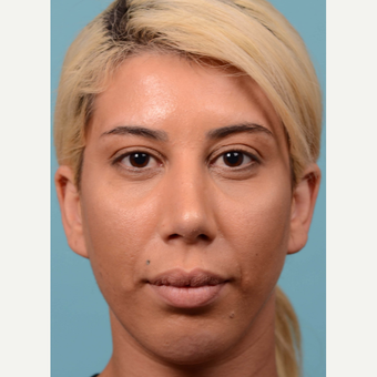 25-34 year old woman treated with Rhinoplasty and chin implant after 3064703