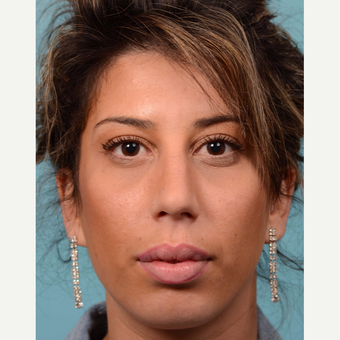 25-34 year old woman treated with Rhinoplasty and chin implant before 3064703