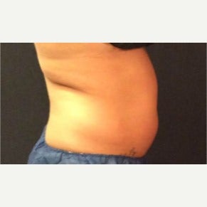 35-44 year old woman treated with CoolSculpting before 2010034