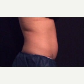 35-44 year old woman treated with CoolSculpting after 2010034