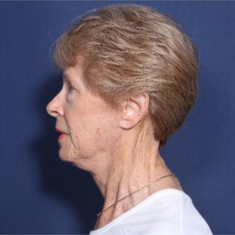 65-74 year old woman treated with Neck Lift (view 2 of 2) after 3179888